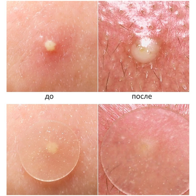 Патчи от прыщей ELIZAVECCA Witch Piggy Hell Pore Blemish Spot Patch 44 шт