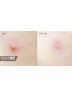 Точечные патчи анти-акне SKINFOOD Tea Tree Secret Spot Patch - 12 шт