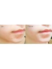 Точечные патчи анти-акне SKINFOOD Tea Tree Secret Spot Patch - 12 шт