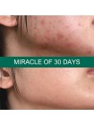 Пенка для проблемной кожи SOME BY MI 30 Days Miracle Acne Clear Foam - 100 мл