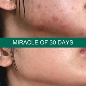 Пенка для проблемной кожи SOME BY MI 30 Days Miracle Acne Clear Foam - 100 мл