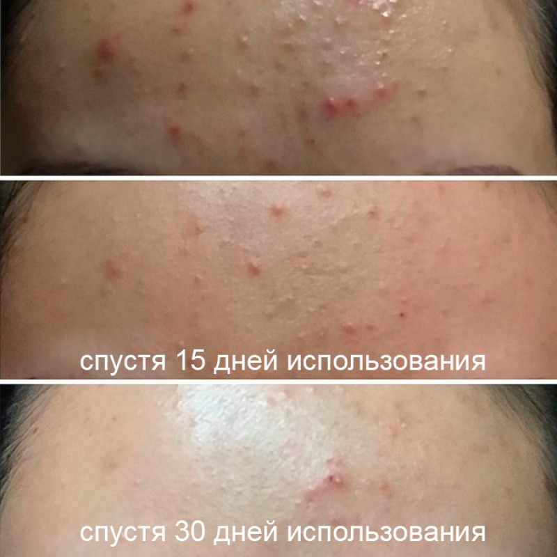 Кислотная сыворотка для проблемной кожи SOME BY MI AHA BHA PHA 30 Days Miracle Serum - 50 мл