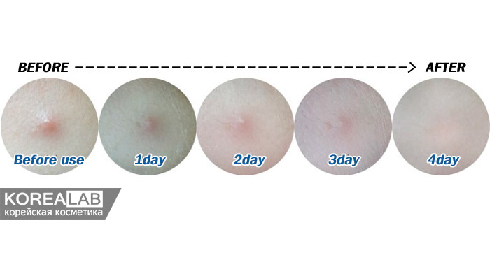 Патч от угрей MISSHA Speedy Solution Anti Trouble Patch