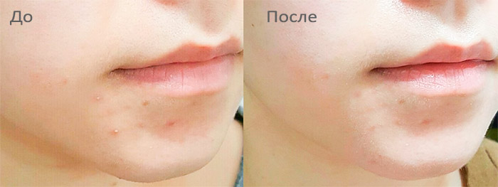 Точечные патчи анти-акне SKINFOOD Tea Tree Secret Spot Patch