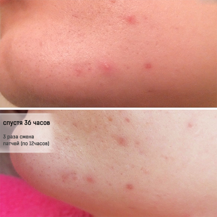 патчи от прыщей tonymoly