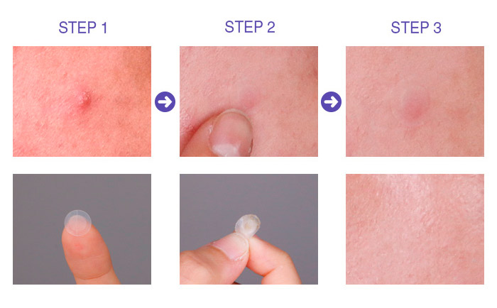 Патчи от прыщей MIZON Bye Bye Pimple Patch