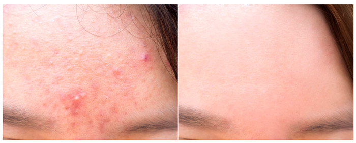 Мыло с кислотами для проблемной кожи SOME BY MI AHA-BHA-PHA 30 Days Miracle Cleansing Bar